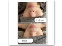 ミィ(miii)の雰囲気（小顔＋美白でたるみやもたつき、くすみなどをリセット致します）