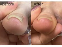 ロンディネ(Rondine)/巻き爪&ネイルトリム