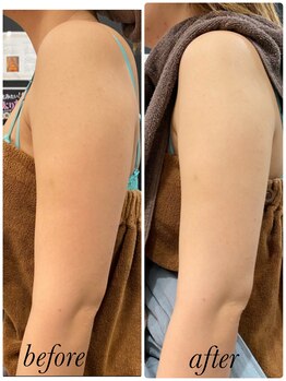 スパチャーレ(Spa ciare)/脂肪分解液を高速導入