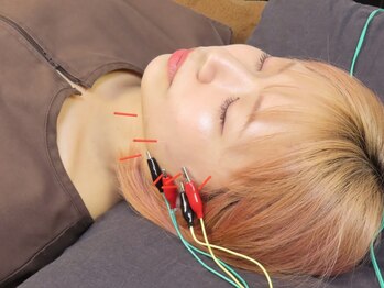 一樹鍼灸院の写真/【美容鍼で小顔美人に！】キュッとした理想のフェイスラインへ◎一人一人のお肌のお悩みに徹底アプローチ！