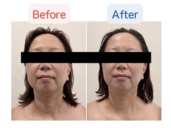 ソルーブ 広尾店/¥地域最安値/韓国肌育ピーリング