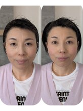 ワヒネ(WAHINE)/小顔矯正1回でこの変化！