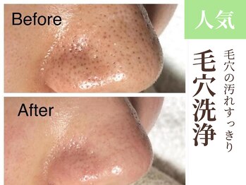 グラシーズ(Glasses)/毛穴洗浄で小鼻の黒ずみすっきり