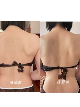 モア(MOA)/上半身集中リンパドレナージュ