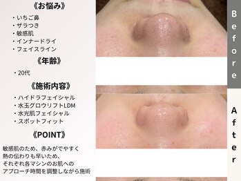 ルディラ 大宮店/ハイドラフェイシャル