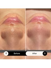 ホイップスパ(WHIP SPA)/毛穴洗浄【1度の効果】