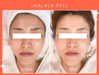 ハノハノ 八代店(HANO HANO)/韓国肌管理ララピール☆