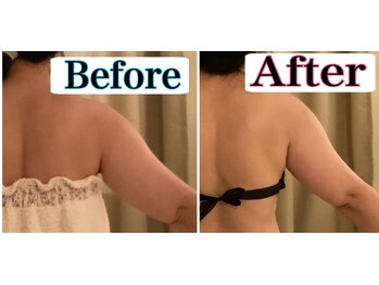 トータルビューティーサロン 凛/二の腕にダイレクトアプローチ