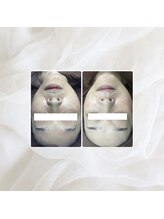 プリマプリート 名駅店/プラズマフォト×スノーピール