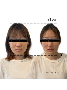 アロラヴィ(AroRavi)/大口式小顔矯正