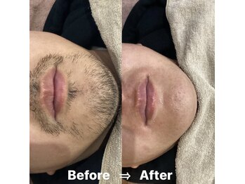 ルージュ 久留米(Rouge)/髭wax脱毛!