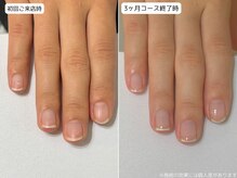 カピリナ(Ka Pilina)/自爪育成・深爪・川崎