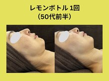 アユアラングレース/レモンボトル1回