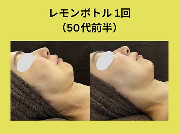 アユアラングレース/レモンボトル1回