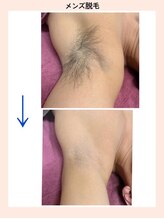 リファイン(REFINE)/メンズ脱毛部位別メニューあり！