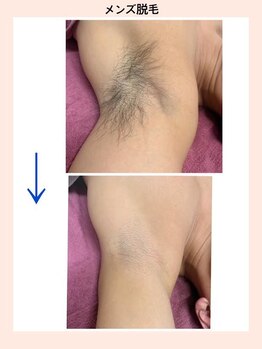 リファイン(REFINE)/メンズ脱毛部位別メニューあり！