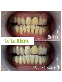 ルブラン 奈良店(Le Blanc)/白い歯で笑顔の印象UP!
