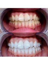 ライトケアサロン 表参道店(Light Care Salon)/ホワイトニングのビフォア