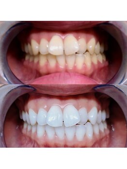 ライトケアサロン 表参道店(Light Care Salon)/ホワイトニングのビフォア