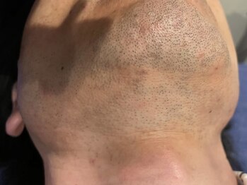 プールオム(Pour Homme)/初回ヒゲ脱毛