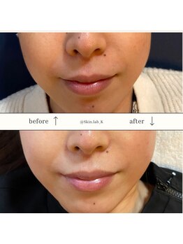 スキン ラボ ケー(Skin lab K)/低温+高濃度美白ケア