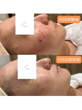 パンジー 上野フェイシャルエステ専門店(pansy)/*フェイシャル/ニキビケア*