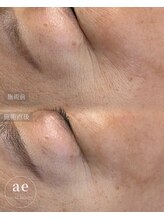 アエ(ae)/ダクトピール