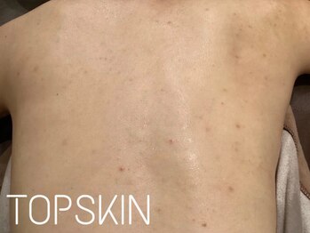 トップスキン 名駅(TOPSKIN)/背中ハーブピーリング♪男性もOK