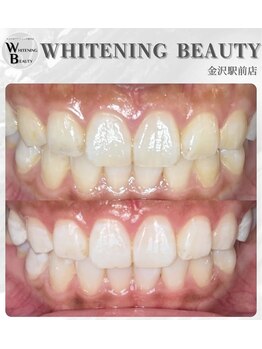 ホワイトニングビューティー 金沢駅前店(WHITENING BEAUTY)/初回でも効果を実感できる!