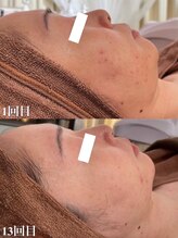 アワピール 天王寺店(AWA PEELL)/ハーブピーリング/ニキビケア