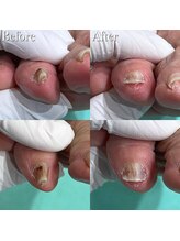 巻き爪補正店 越谷店/巻き爪補正