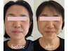 人気No1【脱！もたつき顔】全身から引き上げる根本たるみ改善　80分/19,800→
