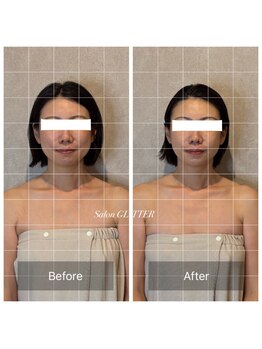 サロン グリッター 新宿(Salon GLITTER)/【小顔】ビフォーアフター