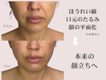 アンジェリカ(Angelica)の写真/【ほうれい線の根本ケア】構造リフトで中顔面ふっくら★口横ぽにょ、口元のもたつきスッキリ！
