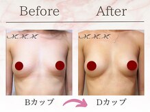 エムエムエム 表参道Luxeサロン(M.M.M)/【バストアップ例】　B→Dカップ