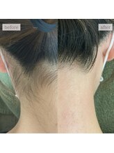 エミライ(emirai)/うなじ脱毛★イベント前に人気