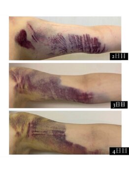 インディバサロン ミイ(MII)/色々な術後ケアにも