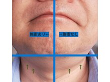 鍼灸院ネクストステップ(鍼灸院NextStep)/半分施術してみました♪