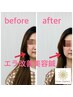 ★エラ改善★通電美容鍼コース（美容鍼＋体の鍼）90分¥19,800→