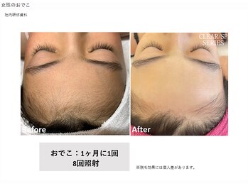 ハナフク(hanafuku)/before→after