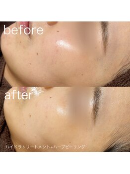 ルルラ リコ(lulula rico)/症例写真/ハーブピーリング