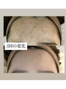 スキンプローズ(skinprose)/お顔ハーブピーリング・ハード