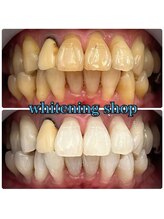 ホワイトニングショップ 池田店/【BEFORE/AFTER】