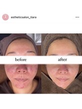 ホワイトアイ 北谷(WHITE EYE)/【ニキビや赤味が気になる方へ】