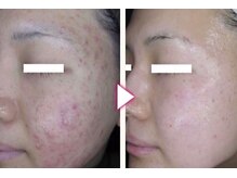 マイン イオンモール浜松市野店/ドクターリセラADS美肌活性