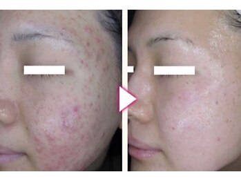 マイン イオンモール浜松市野店/ドクターリセラADS美肌活性