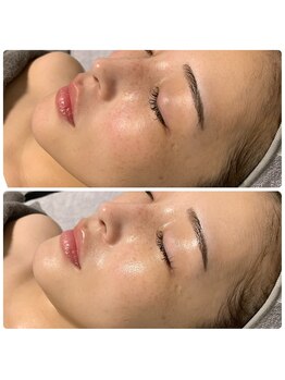 ラグ(LUXU)/オーダーメイドフェイシャル♪