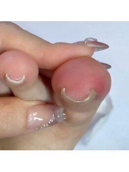 ベルオングル(Bellongle)の写真/ 【深爪改善・巻爪改善】高品質な技術で爪を本来の自然な美しさに改善していきます。 