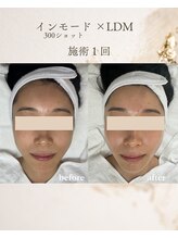 フォルディオ(FORDIO)/インモード半顔×LDM