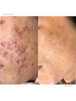 イチロクイチハチ(1618)/長年のニキビケアに